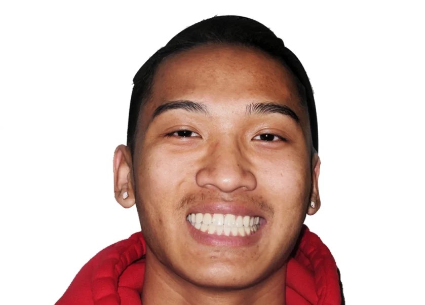 Aftersmile2. Jpg
