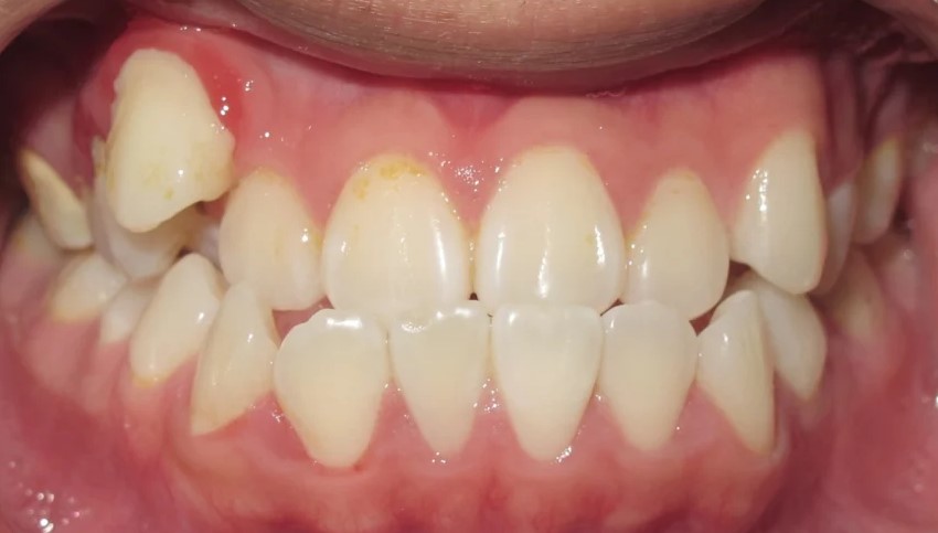 Beforeteeth2. Jpg