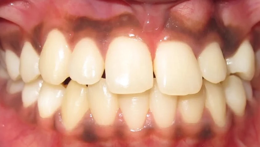 Beforeteeth4. Jpg