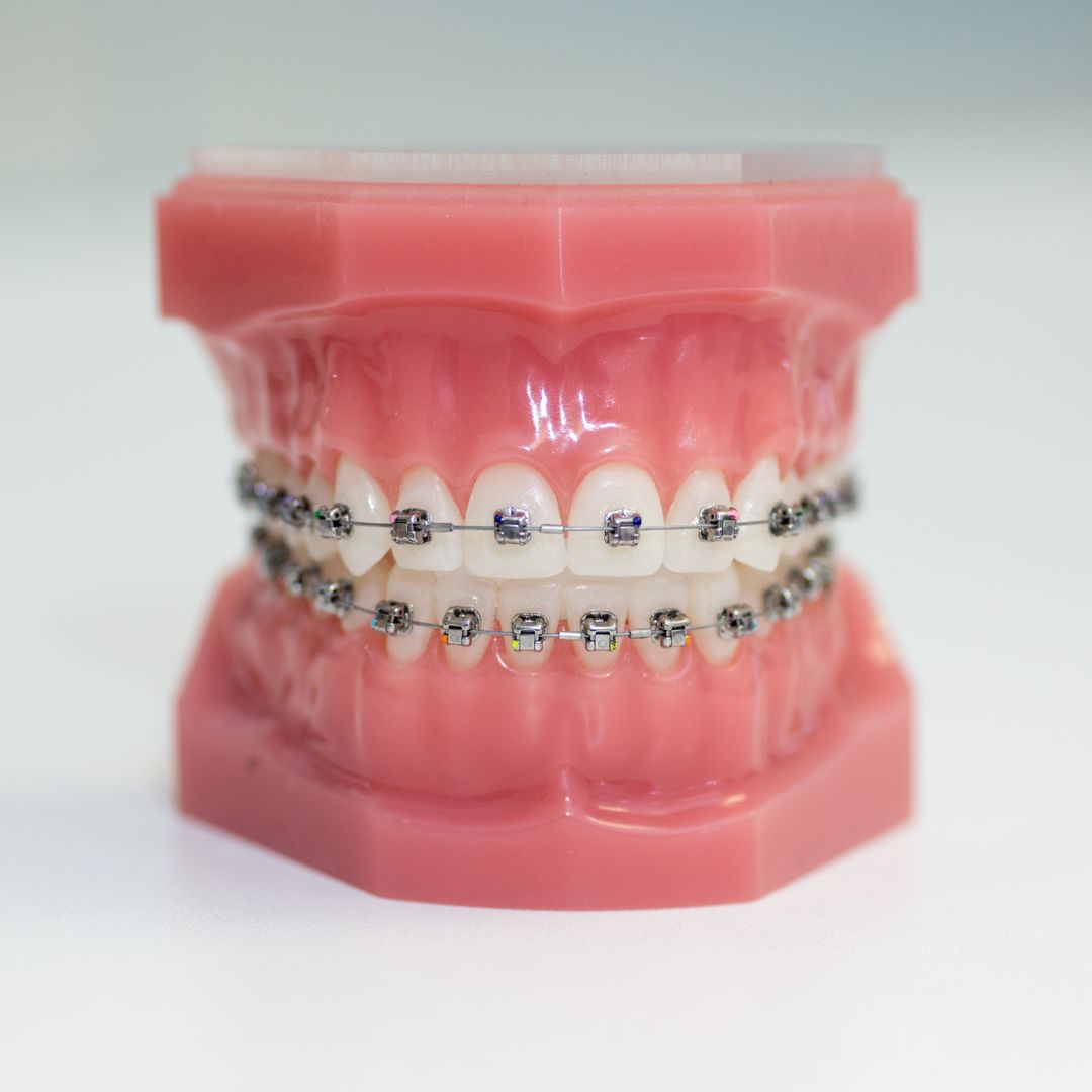 Lingual braces